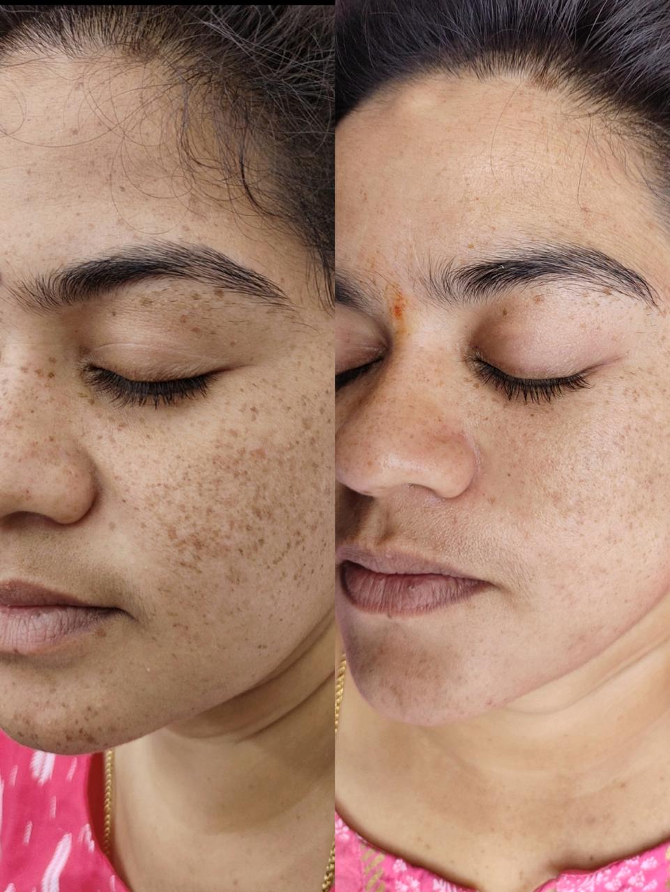 Skin Lightening