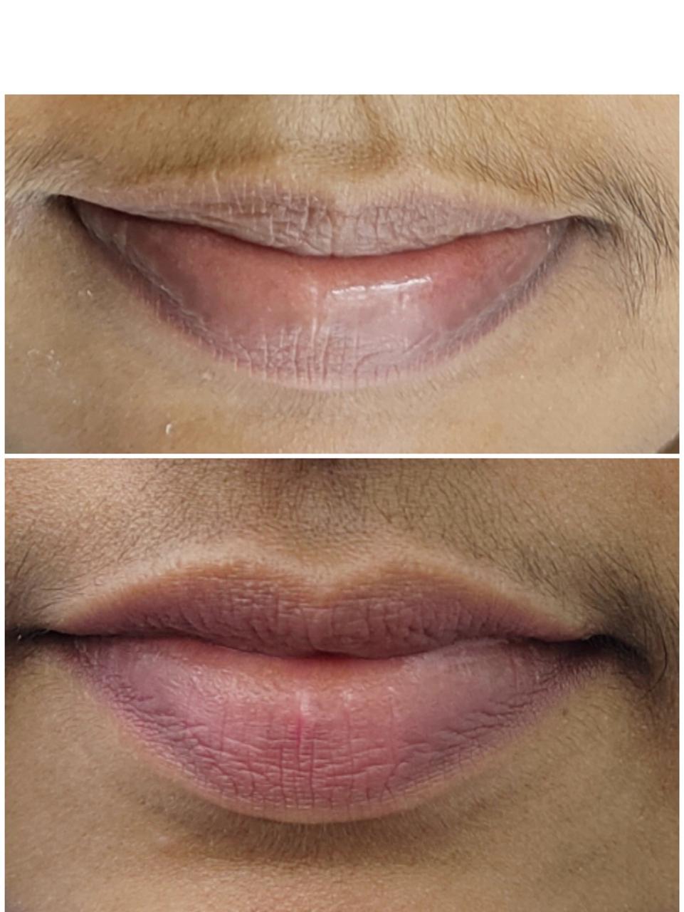 Skin Rejuvenation