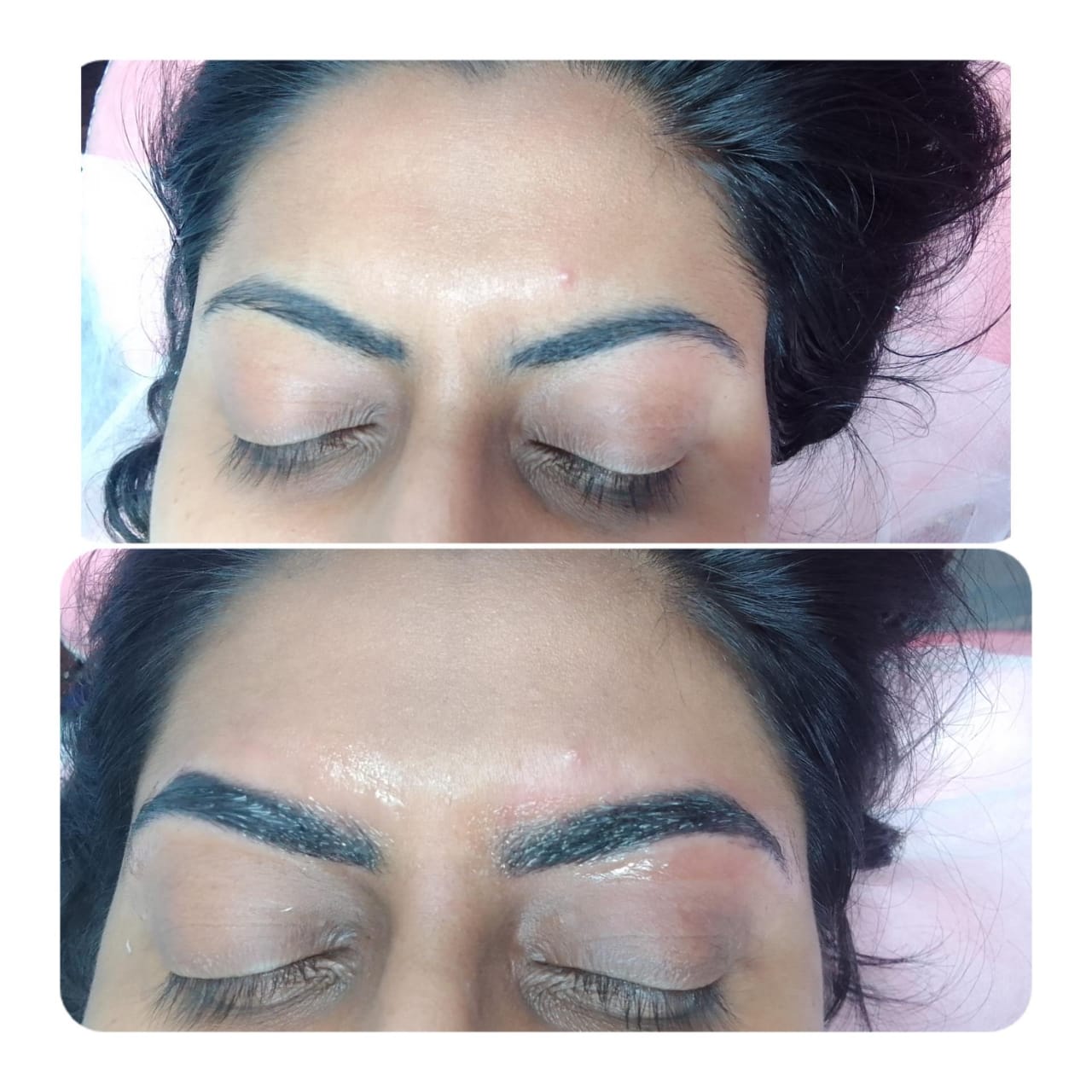 PRP Hair Treatment