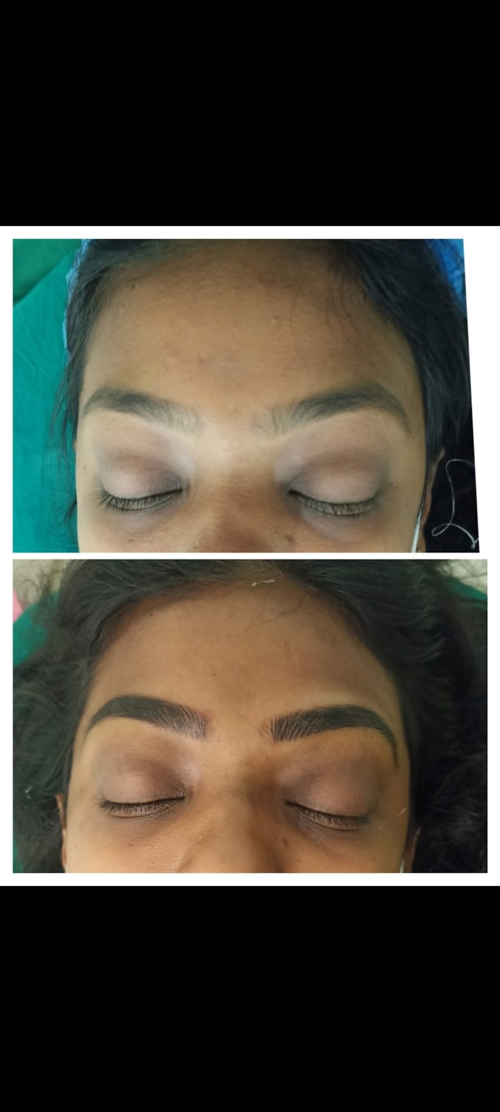Hair Loss Treatment