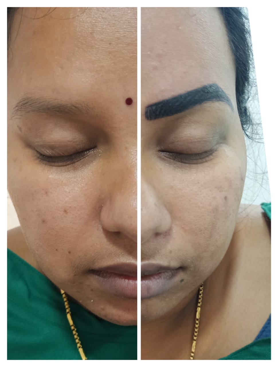 Acne Scar Treatment